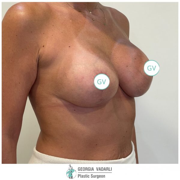 woman-after-breast-surgery