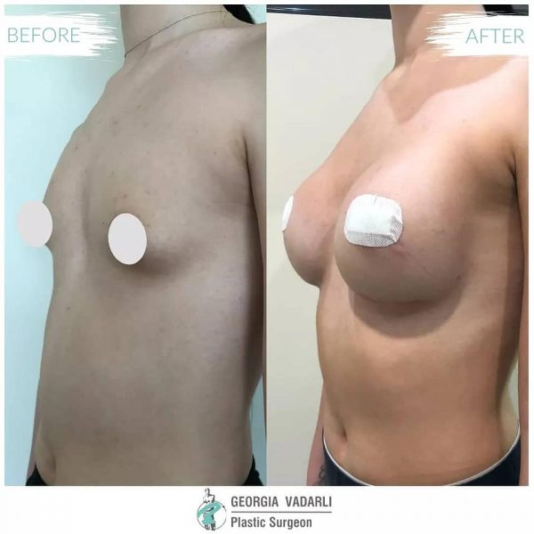 breast-surgery