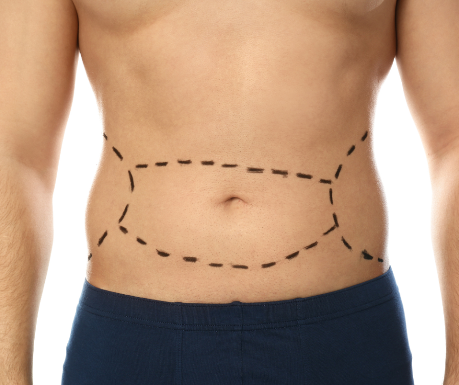 κοιλιοπλαστική man in tummy tuck preparation
